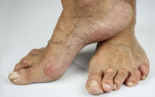 Диагностика и лечение серопозитивного ревматоидного артрита