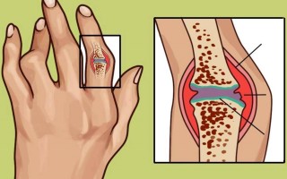 Диагностика и лечение ревматоидного артрита