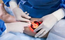 Удаление сосудистой сетки на ногах лазером и другими способами