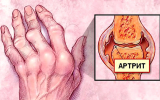 Диагностика и лечение серонегативного ревматоидного артрита