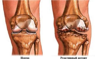 Диагностика и лечение реактивного артрита у взрослых